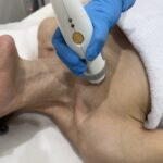 7-RF skin tightening 2
