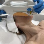 IPL pigment reduction